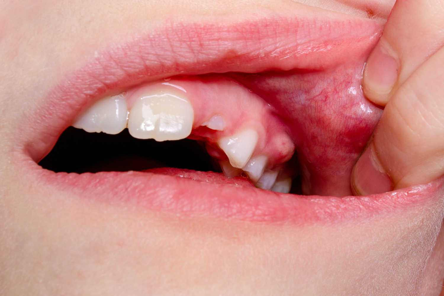 PFAPA Syndrome