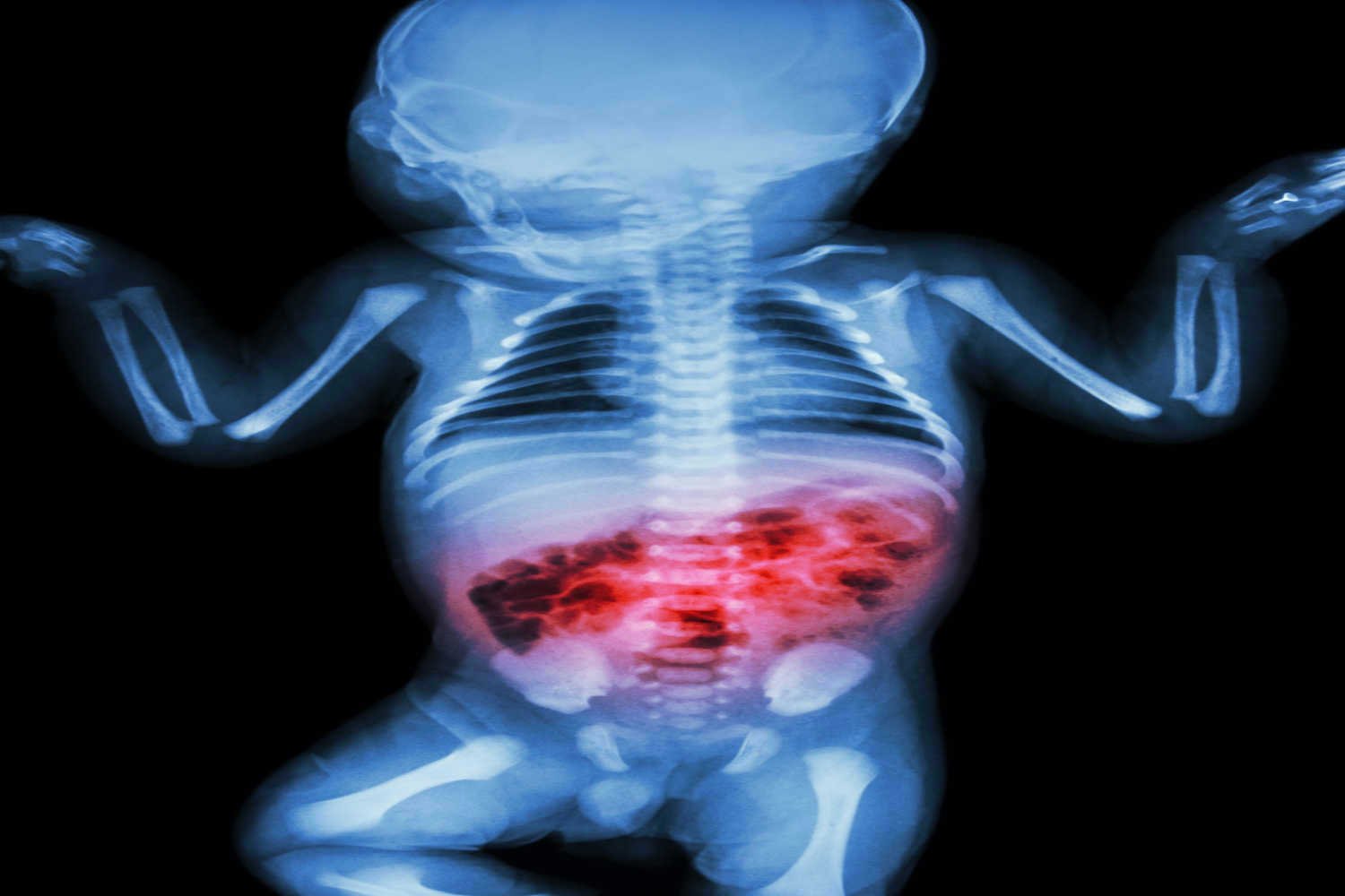 Diagnosis of NEC in Babies