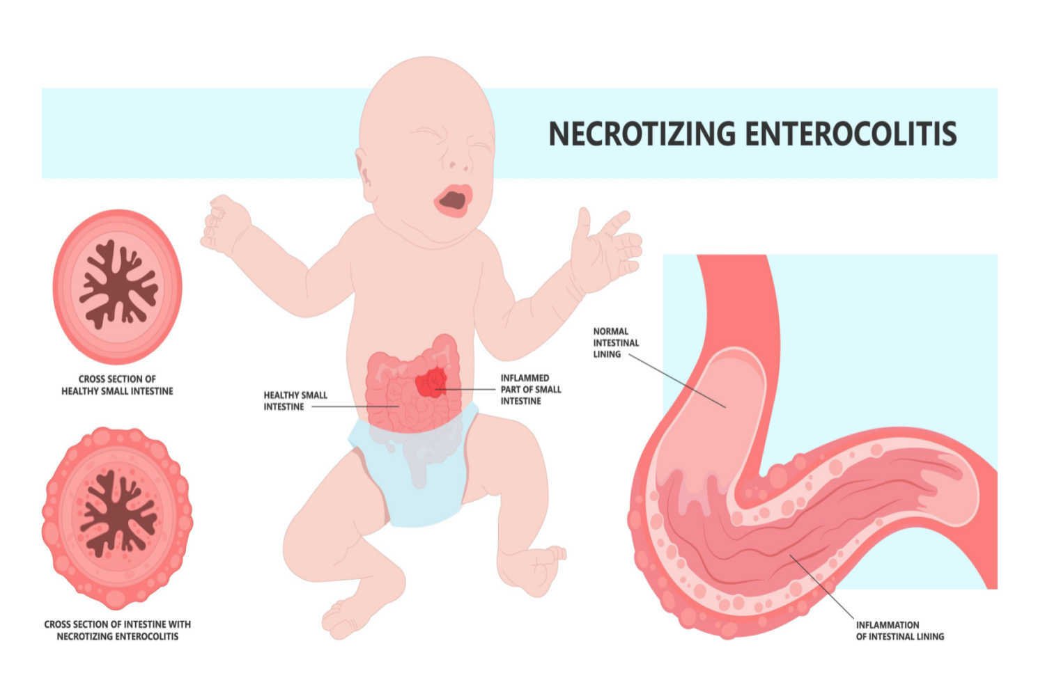 How Common is Necrotizing Enterocolitis in Babies?