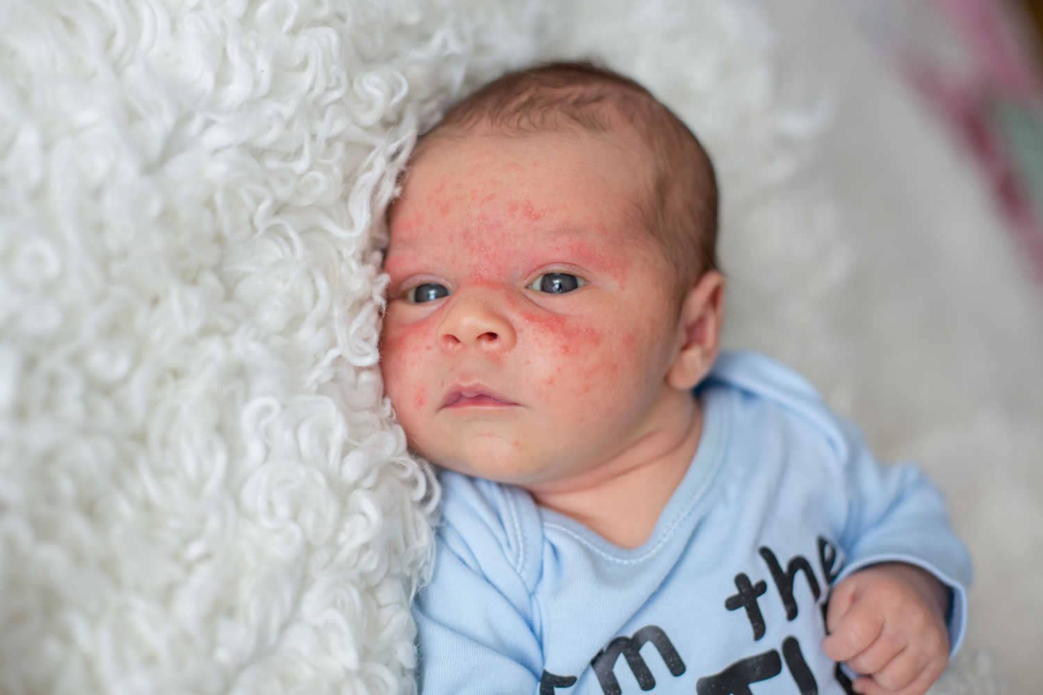 Newborn Eczema Causes, Symptoms And Treatment Being The Parent
