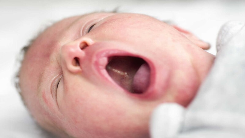 Epstein Pearls in Newborn