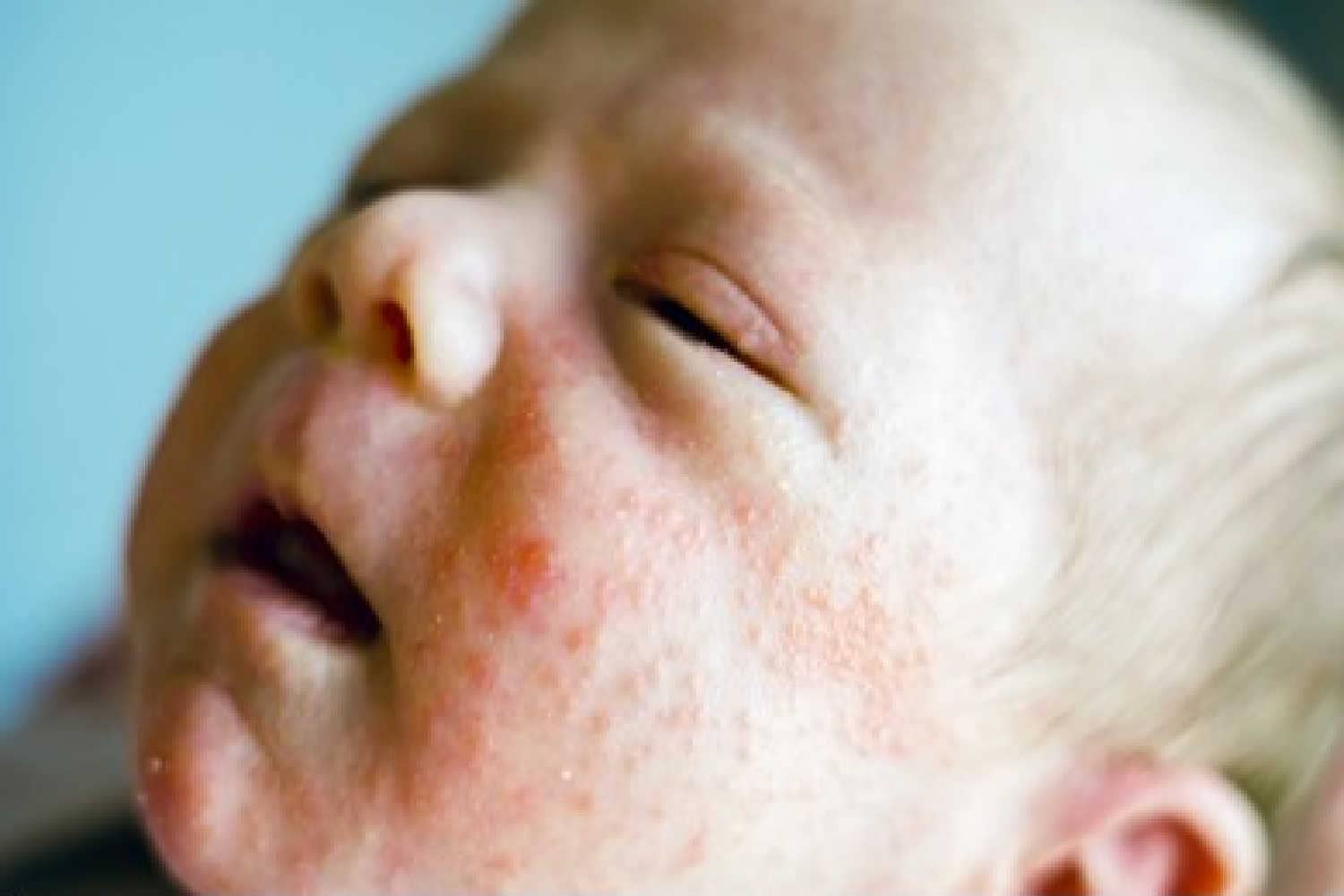 baby acne.