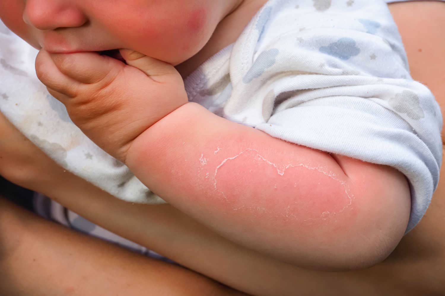 newborn skin burn.