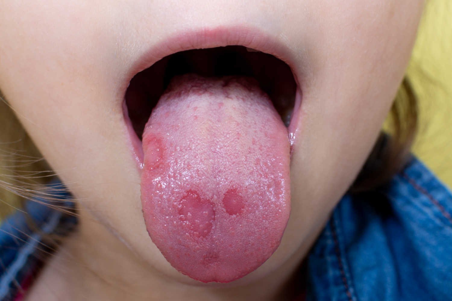 oral ulcer- Signs of Primary Immune Deficiency