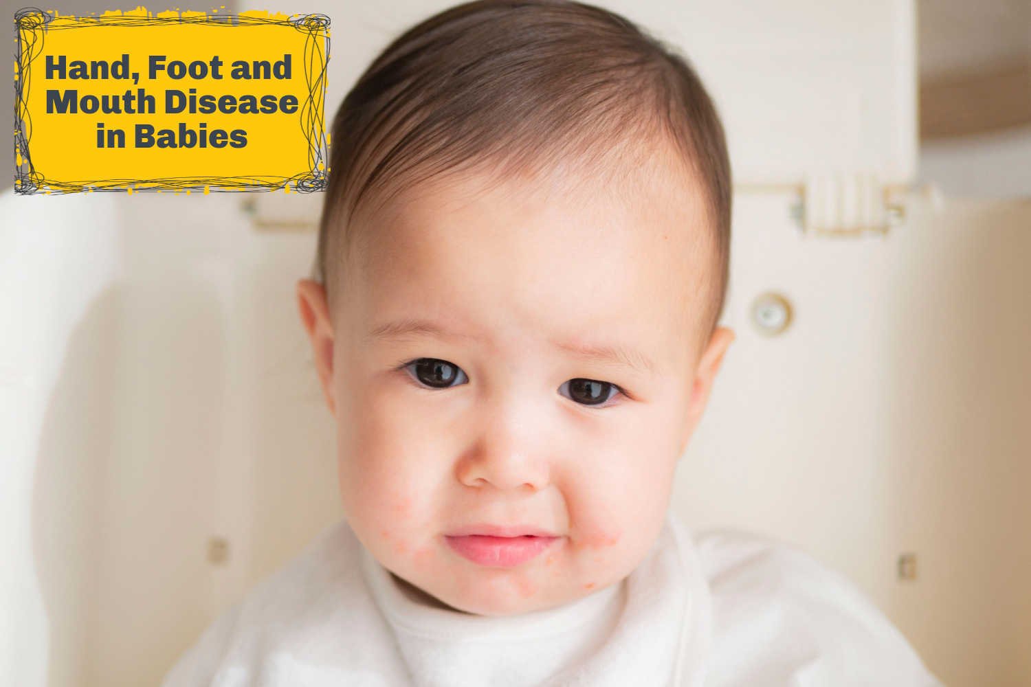 Hand Foot And Mouth Disease HFMD In Babies Home Remedies