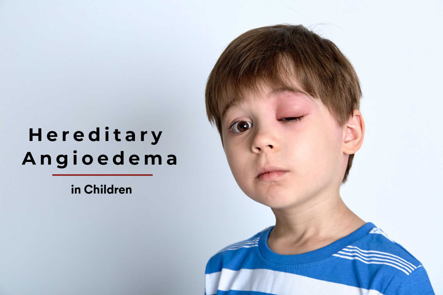 Hereditary Angioedema in Children – Types, Causes and Symptoms by Dr. Sagar Bhattad