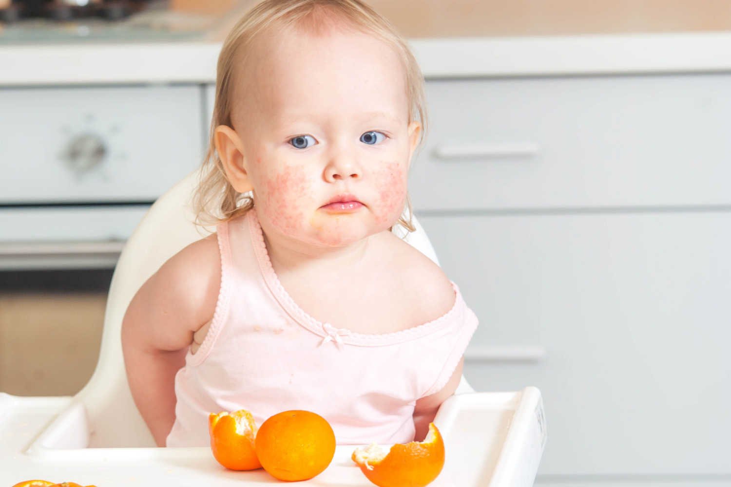 Food Allergies in Babies Signs, Preventive Measures and Treatment