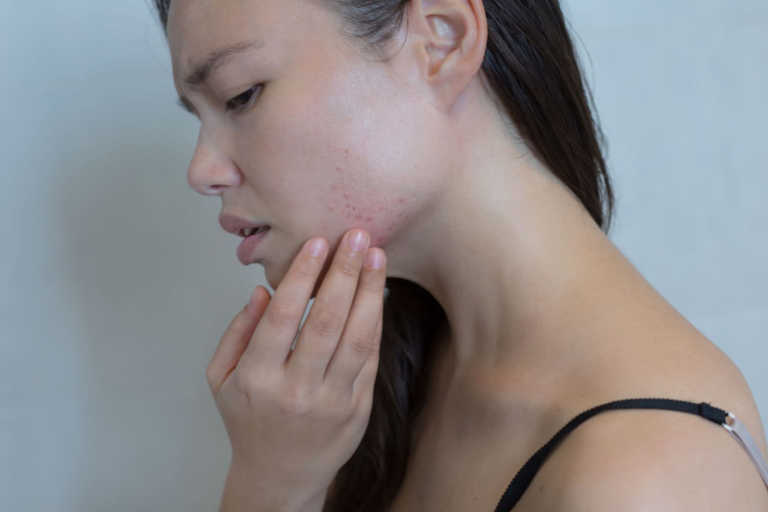 woman with acne on her face during pregnancy