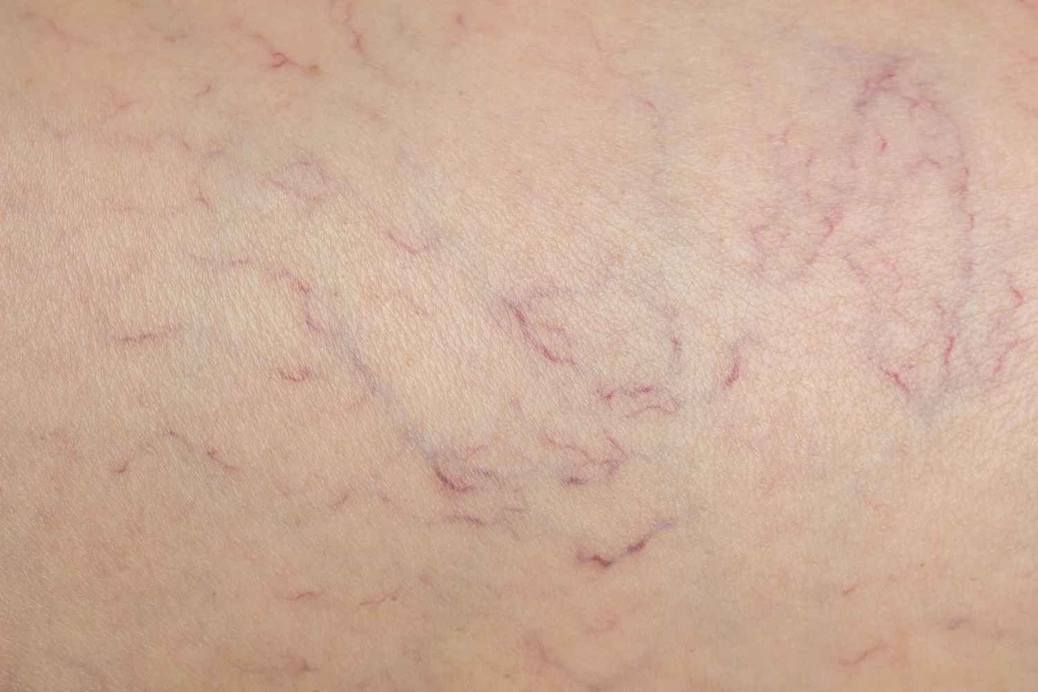 visible veins due to increased blood flow