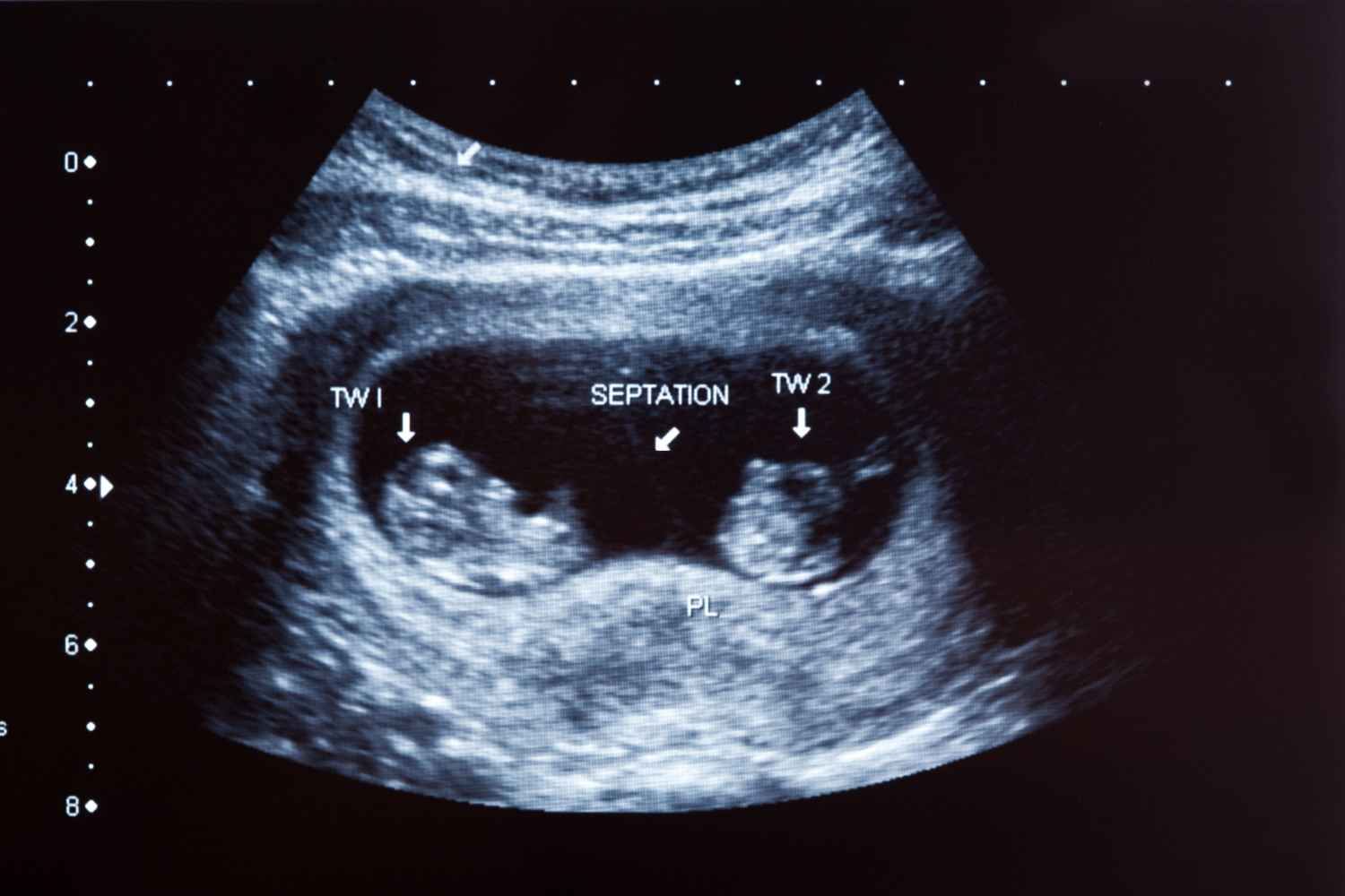 ultrasound revealing a twin pregnancy