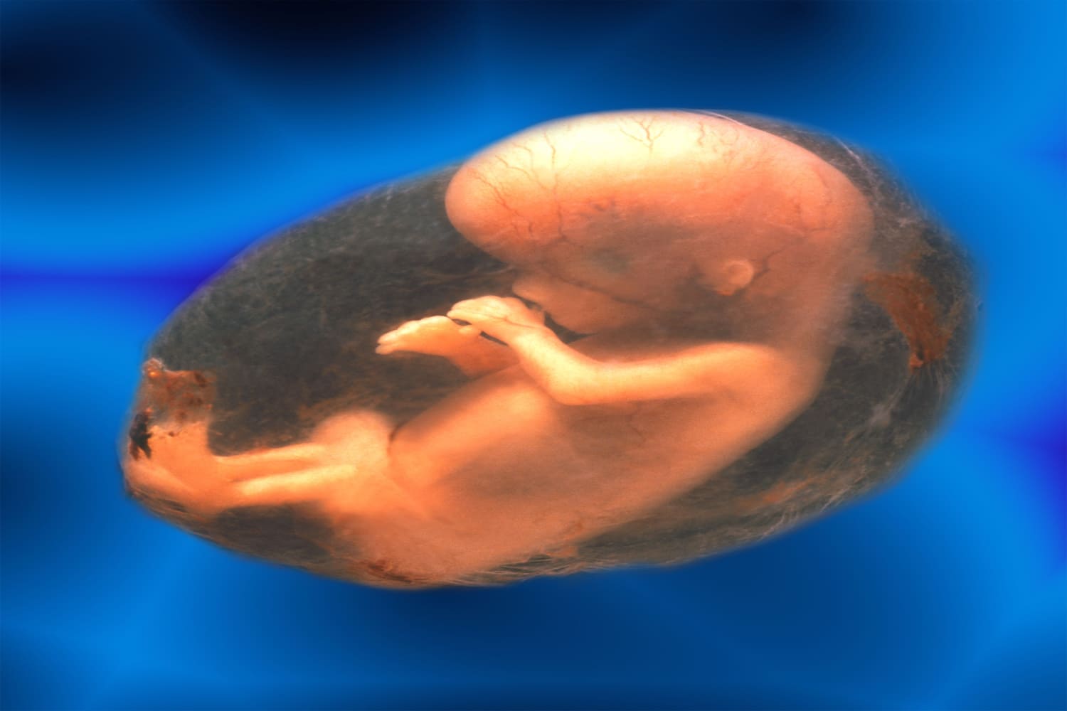 fetus in amniotic sac