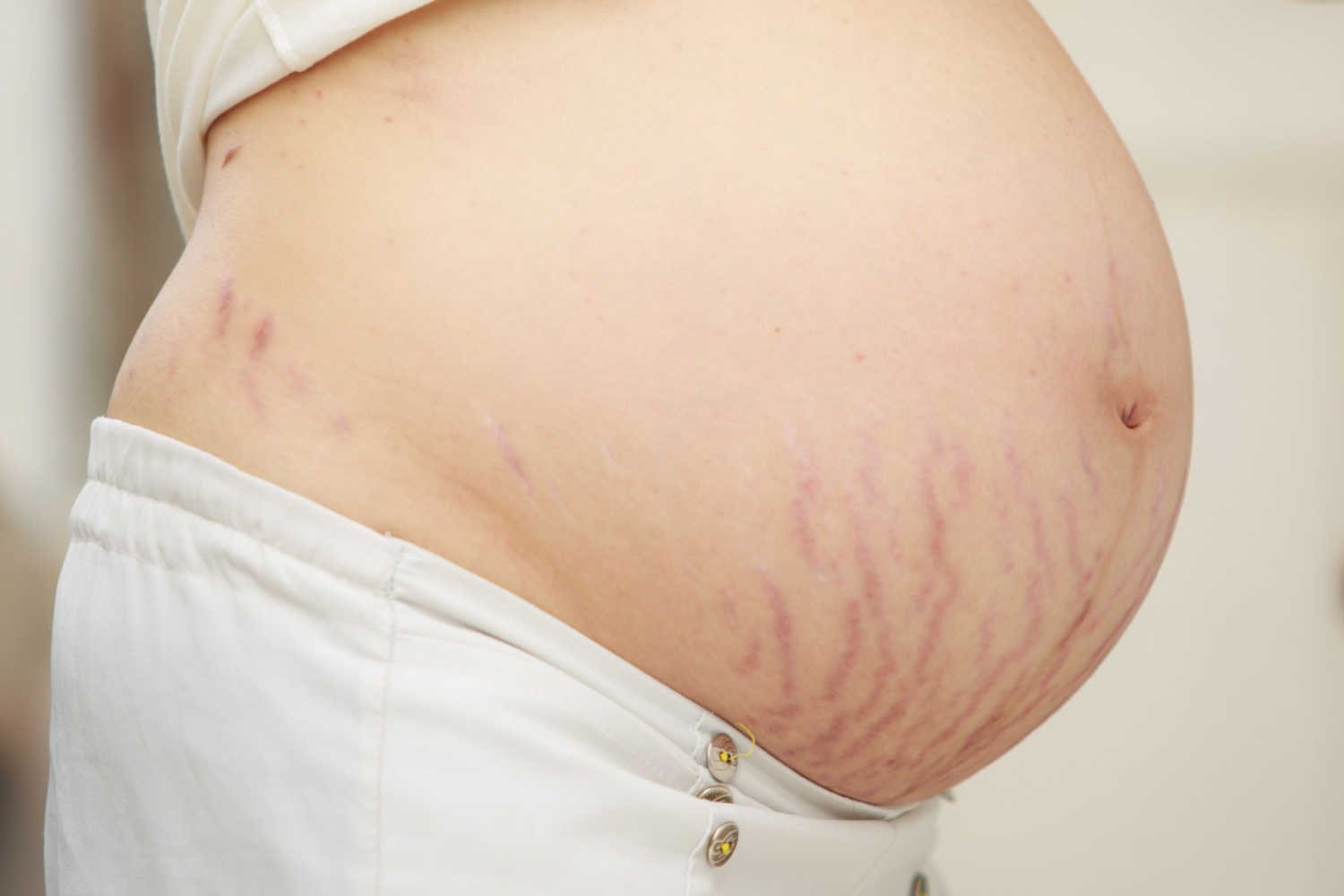 pregnant woman with stretch marks on her baby bump