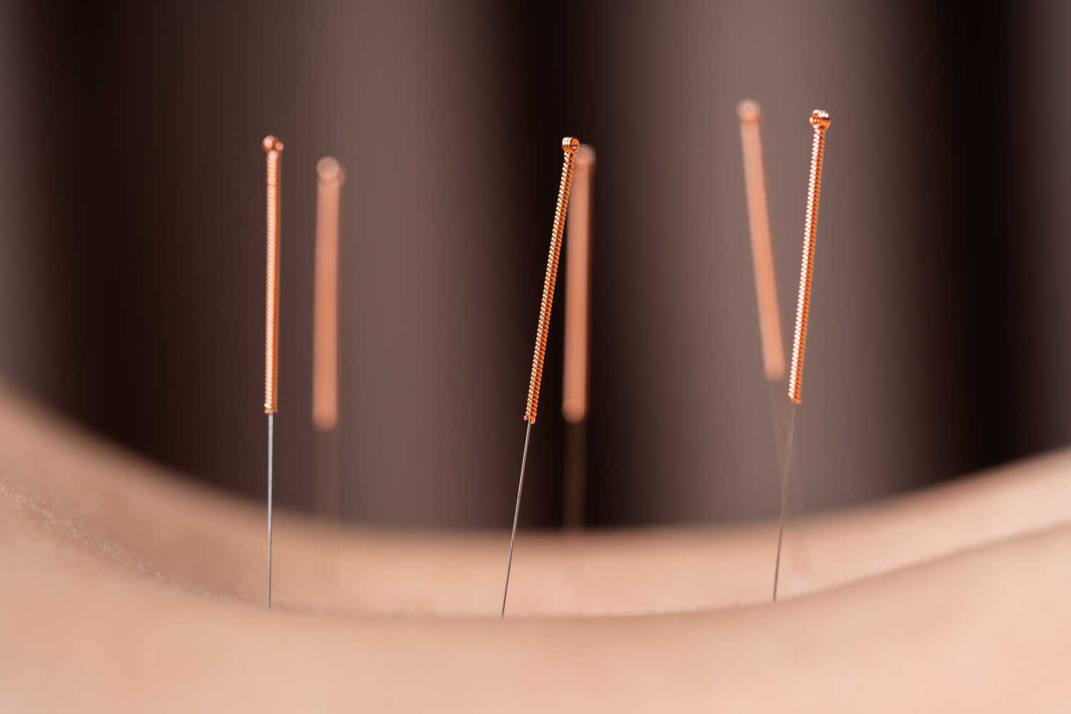 Acupuncture for fertility