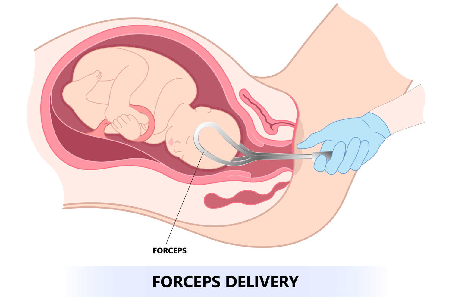 forceps - Types Of Delivery Methods
