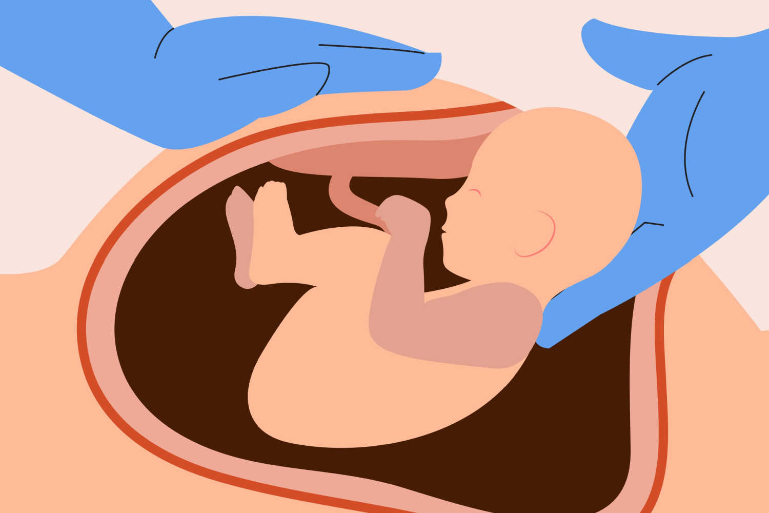 C -section