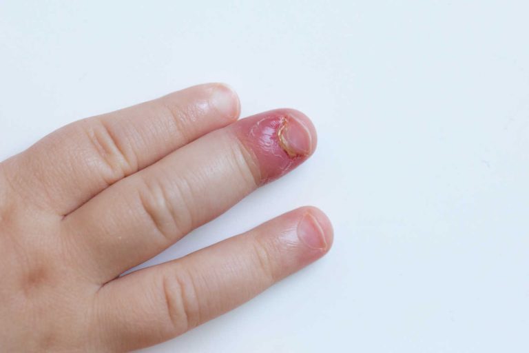 Yeast Infection in Toddlers Causes, Symptoms, and Treatment Being The Parent