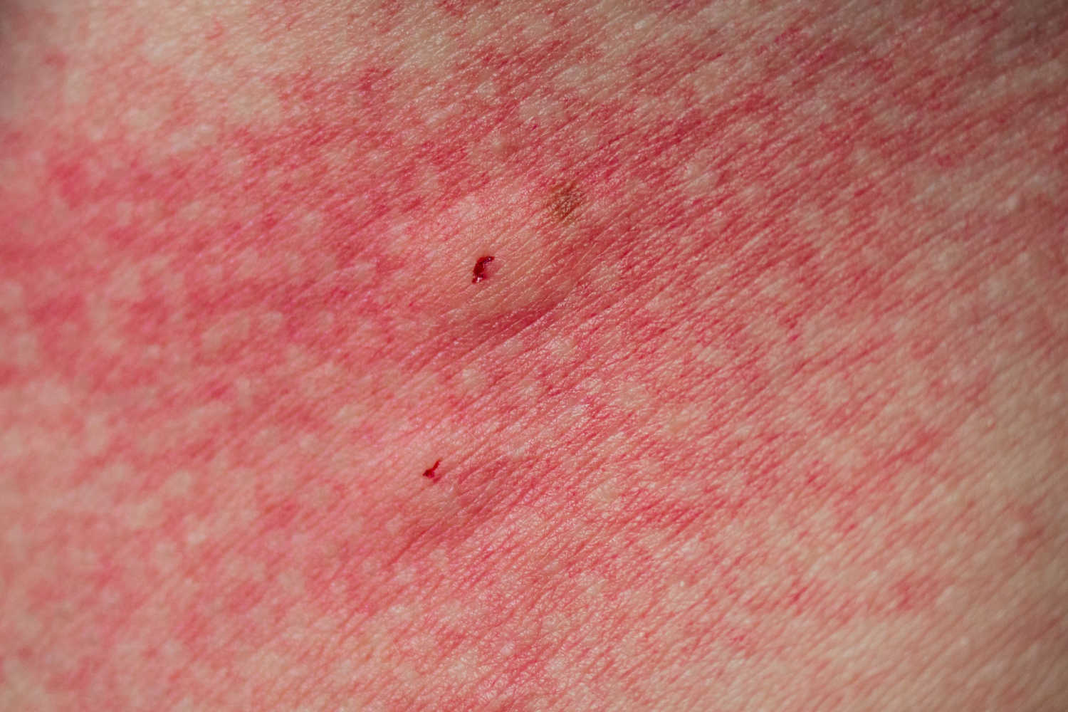 Spider bite symptoms in toddlers