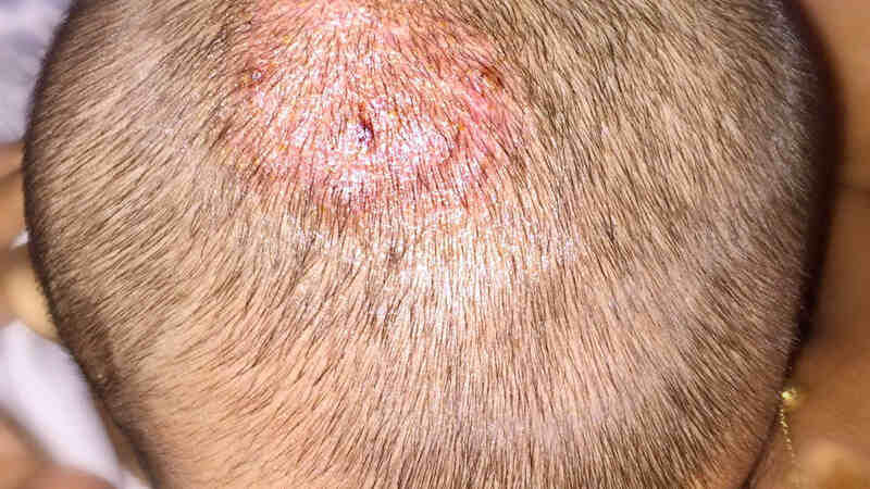 hair loss