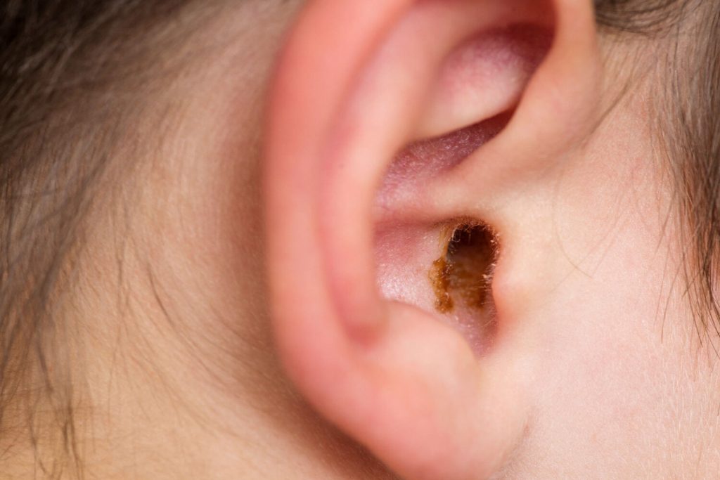 Glue Ear in Toddlers What is it, Causes and Symptoms Being The Parent