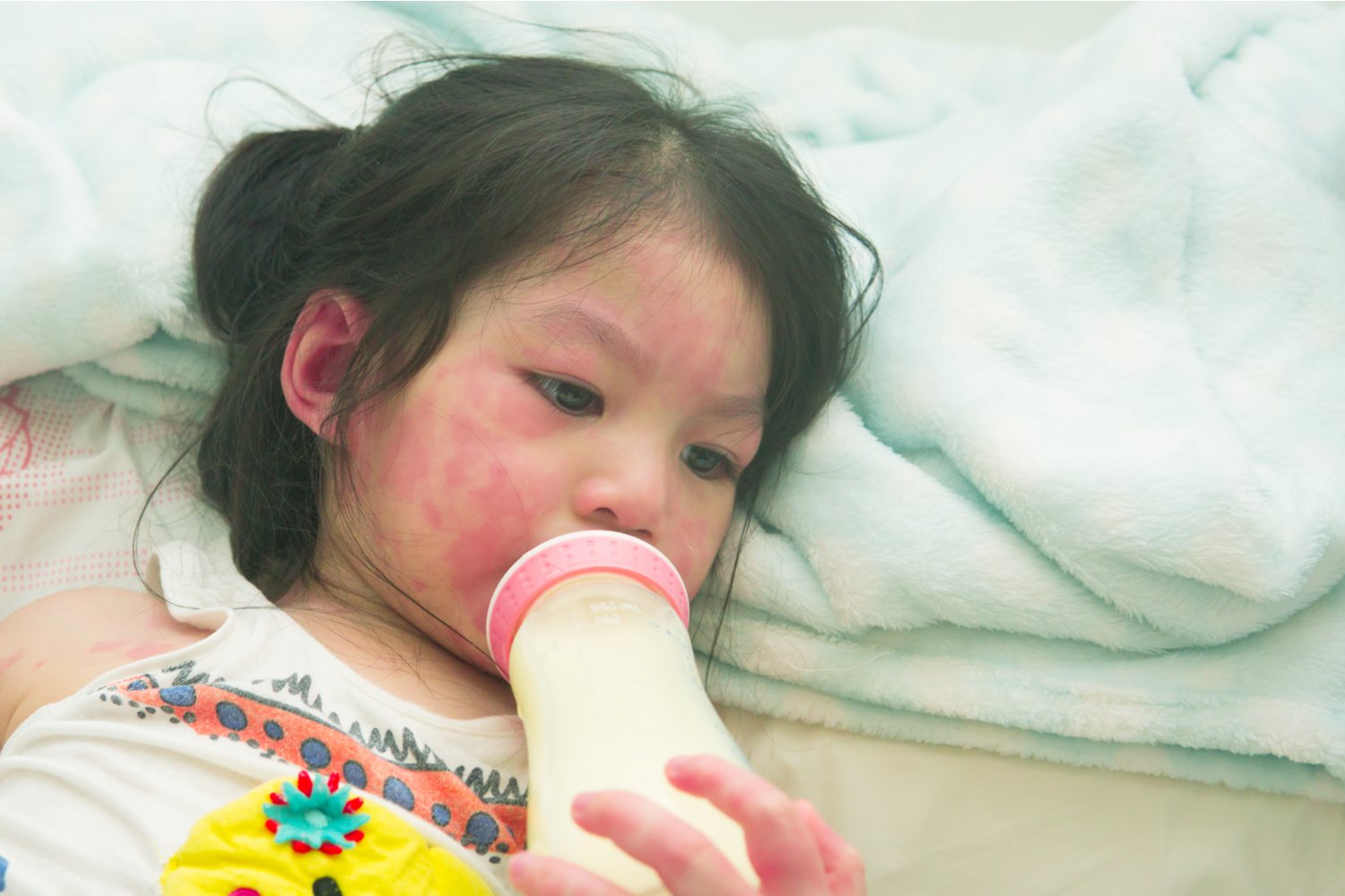 Milk Allergy in Babies Symptoms, Treatment and Precautions Being