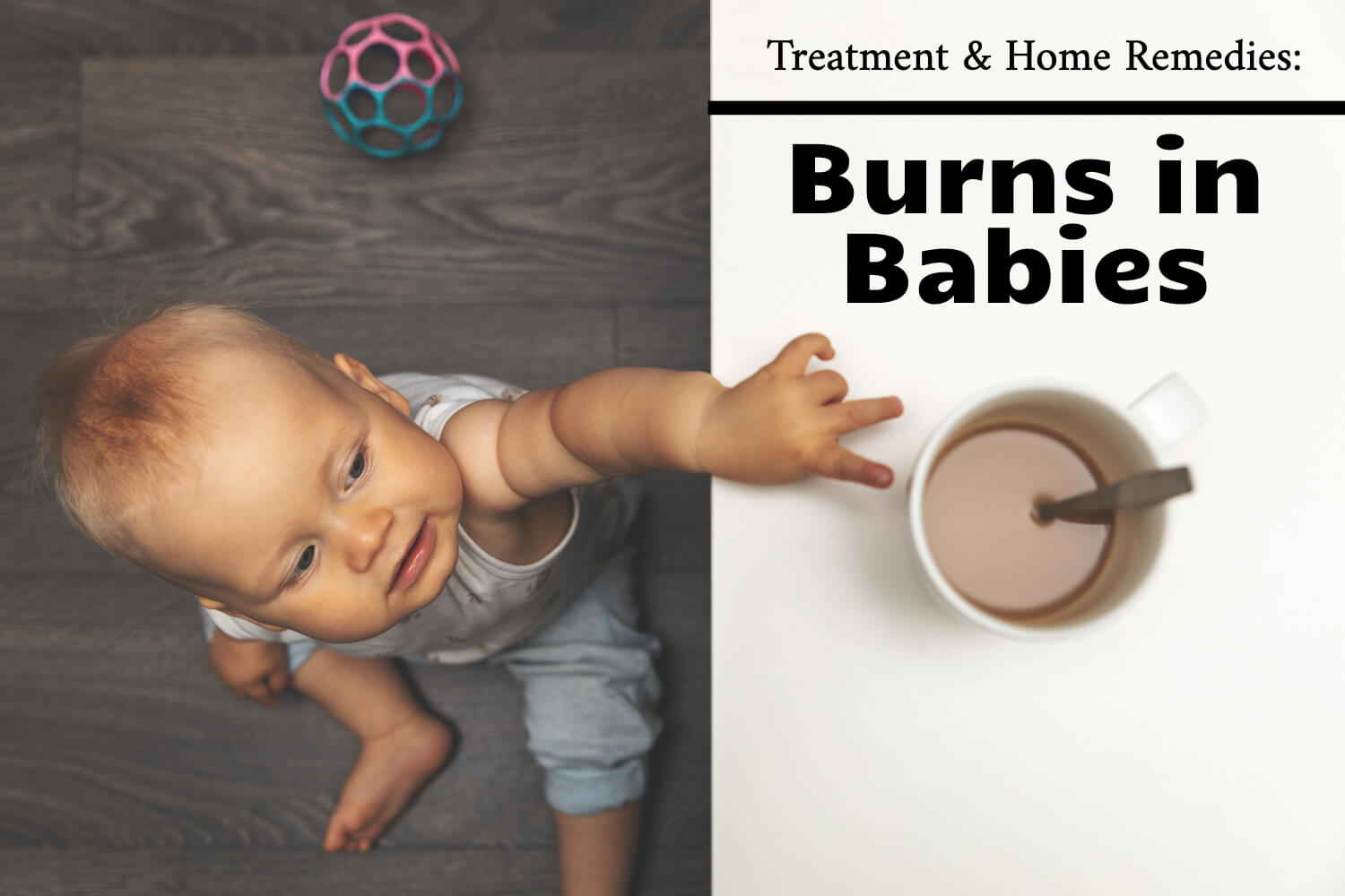 Burns in Babies Treatment and Home Remedies by Dr Chetan Ginigeri