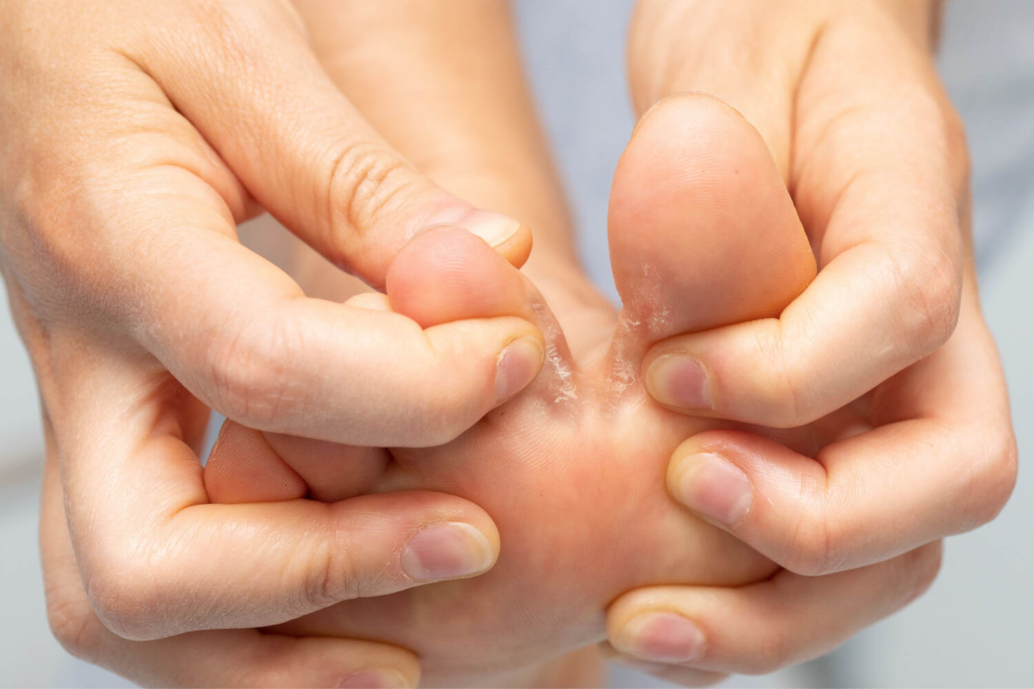 athlete's foot during pregnancy