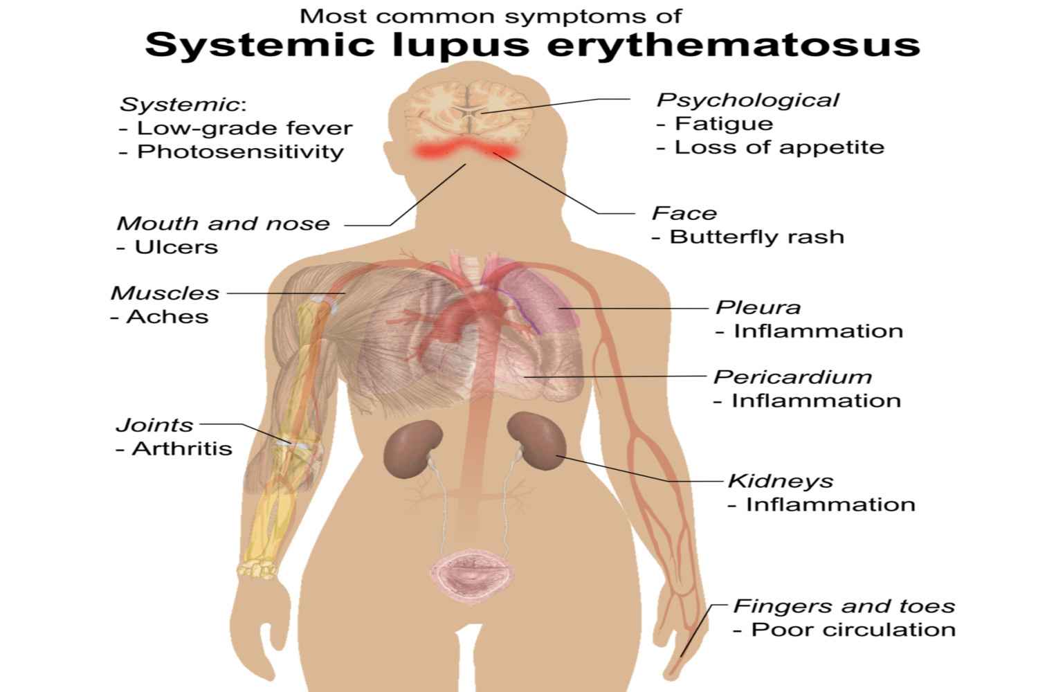 symptoms of lupus