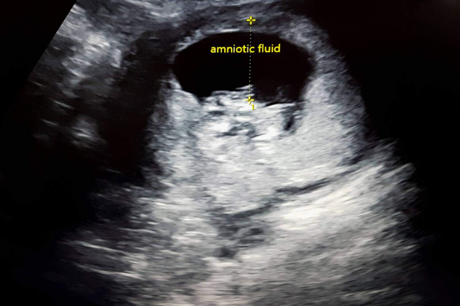 Amniotic-fluid
