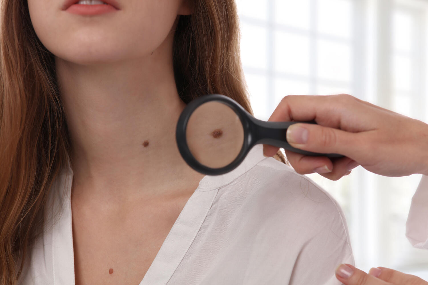 Skin tags during pregnancy
