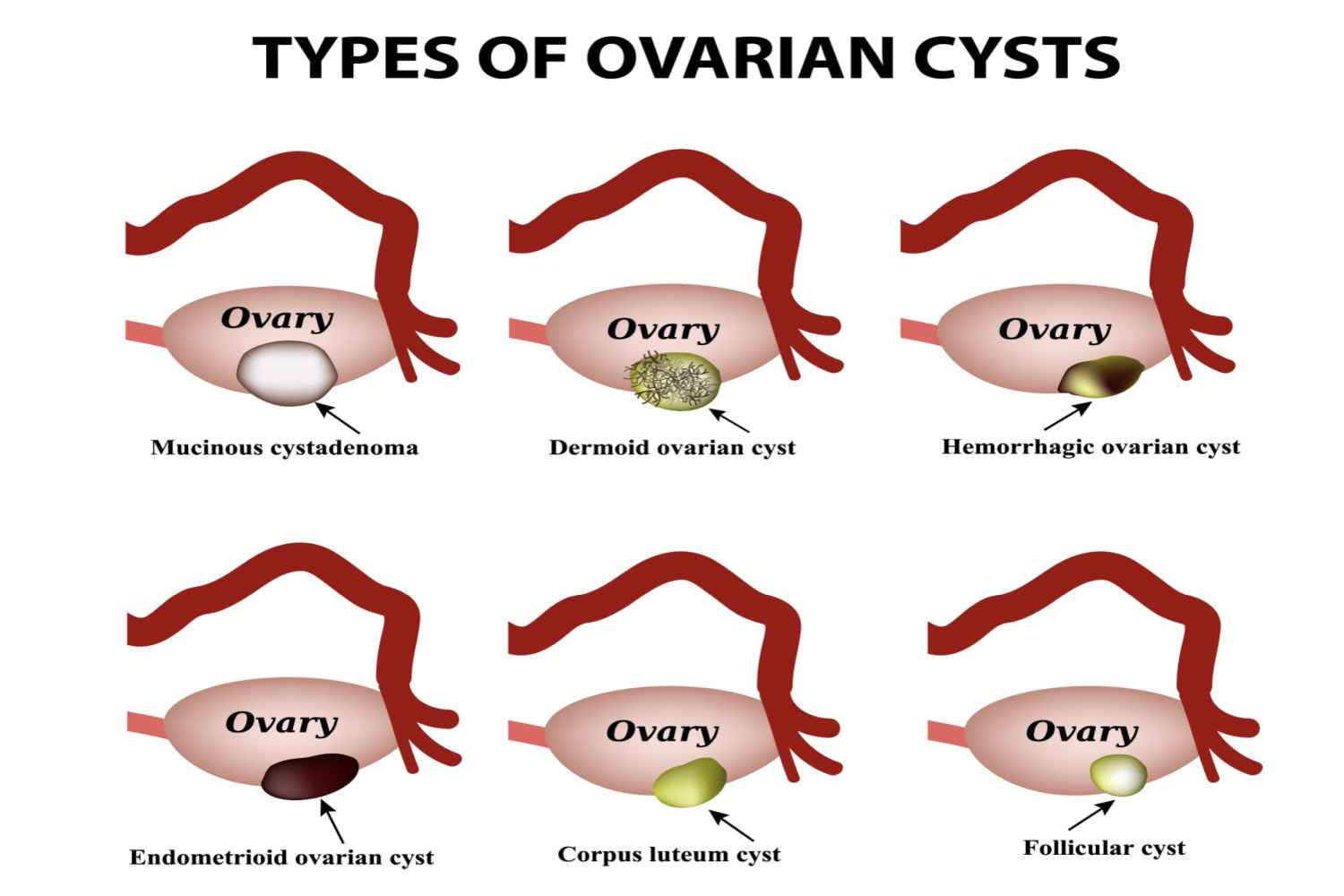 Types of ovarian cysts