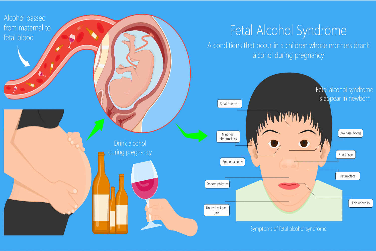 Causes Fetal Alcohol Syndrome