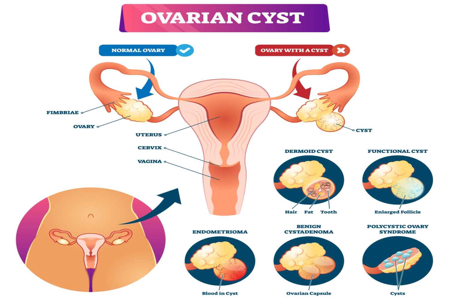 Ovarian Cyst and pregnancy