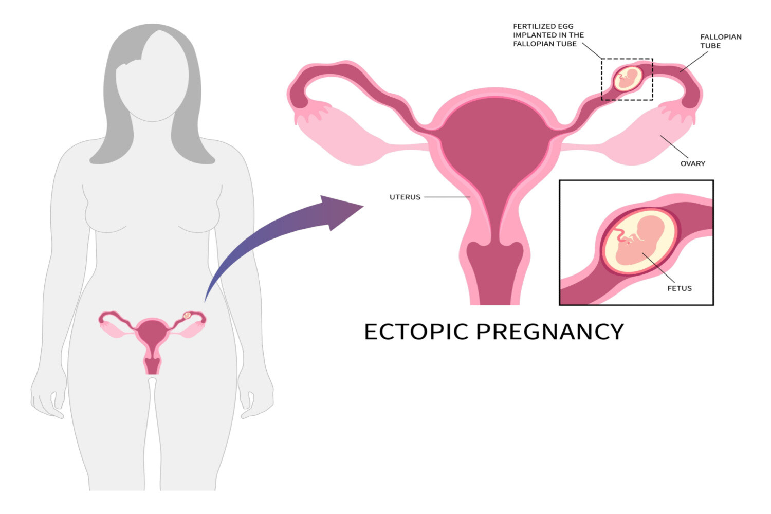 Ectopic Pregnancy and blocked fallopian tubes