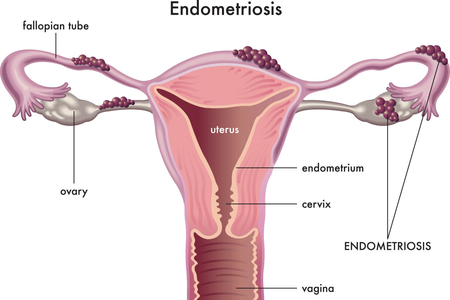 Blocked Fallopian tube causes