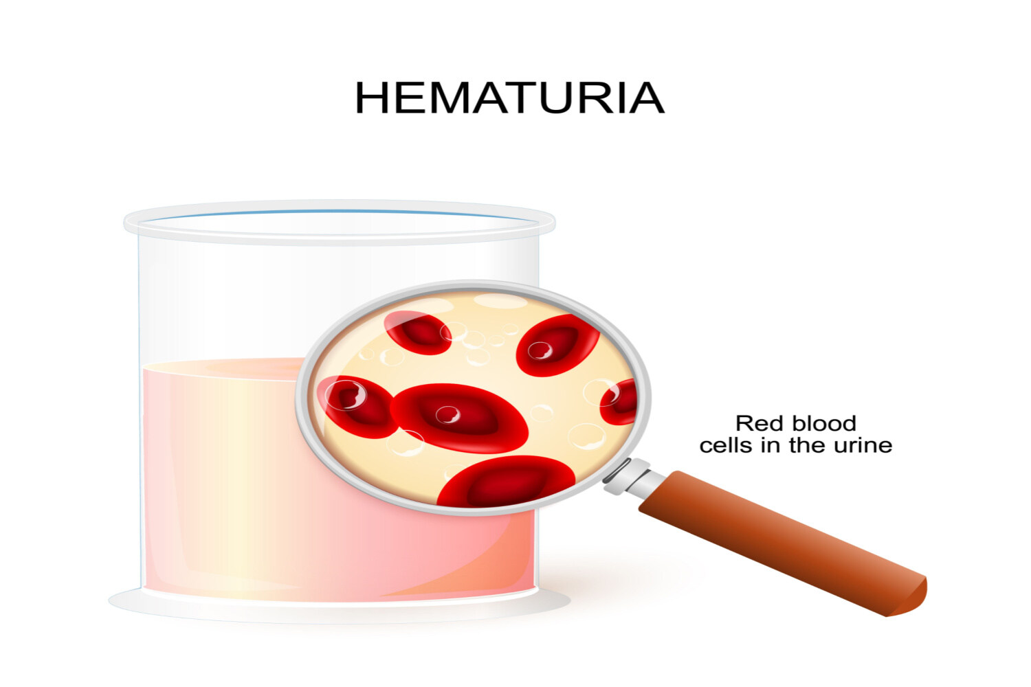 Hematuria in children