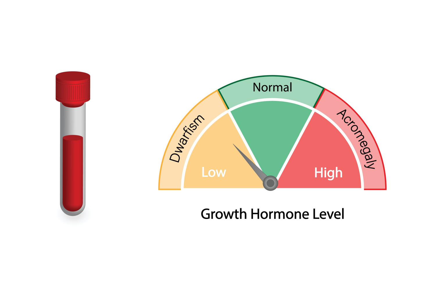 Lack of growth hormone results in dwarfism