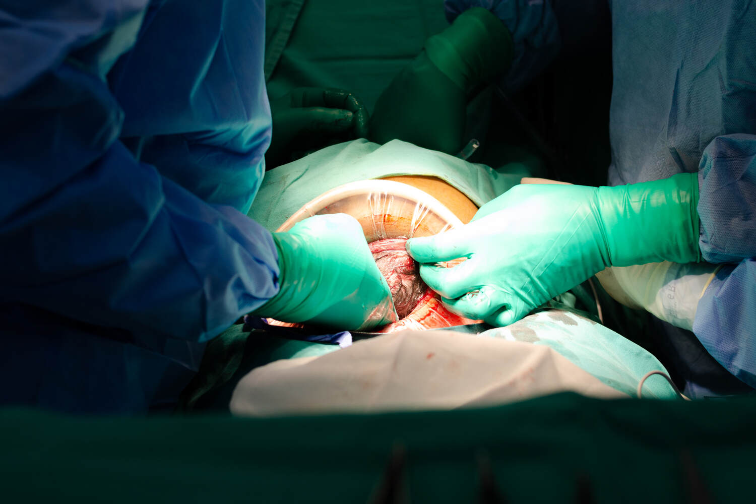 doctors performing c-section
