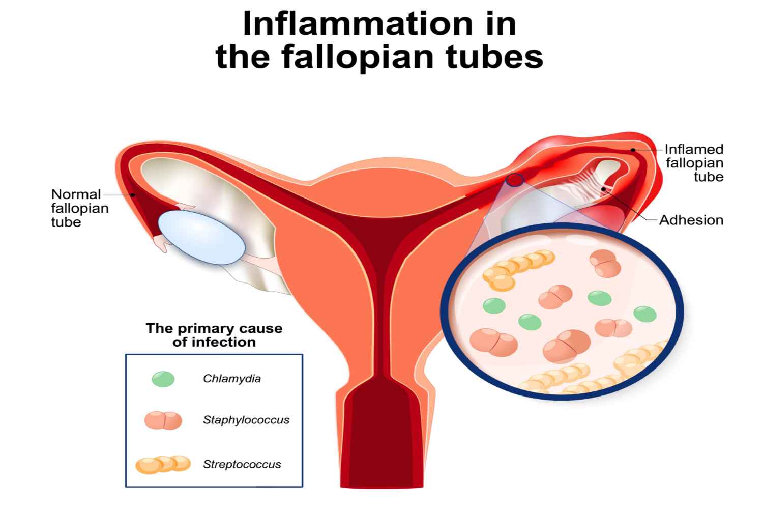 Pelvic Inflammatory Disease(PID) - cause of blocked fallopian tube