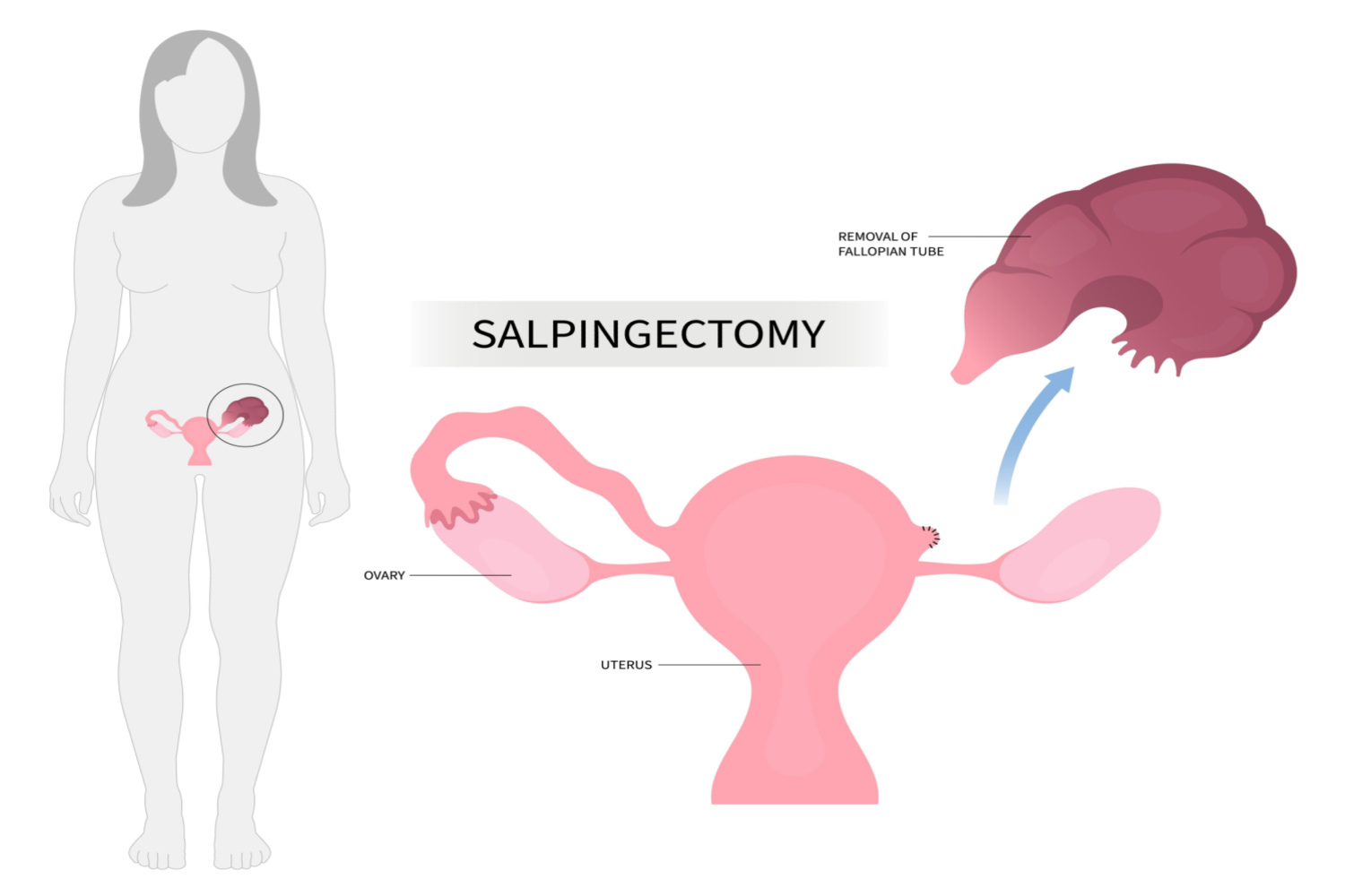 Salpingectomy