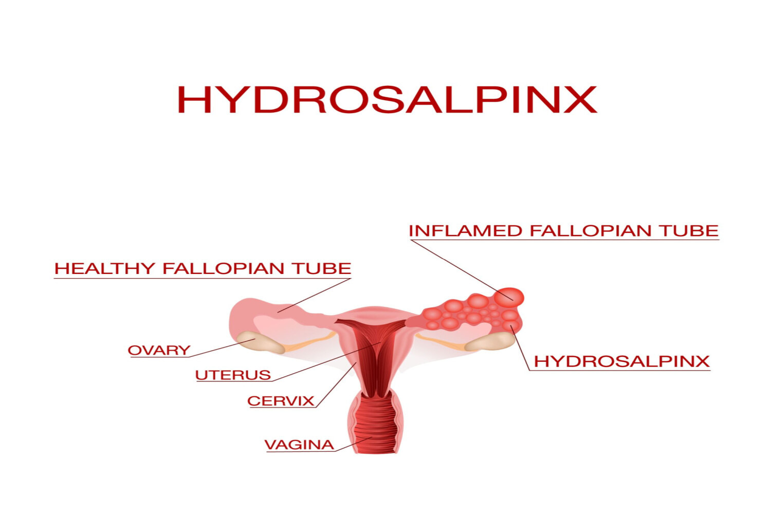 Types of Blocked Fallopian Tubes
