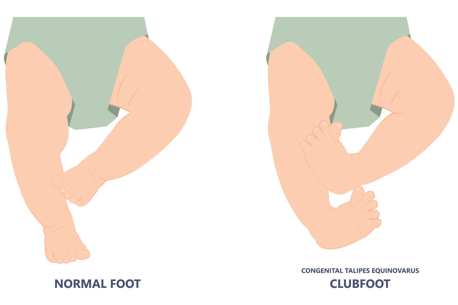 Clubfeet in kids is a sign of dwarfism
