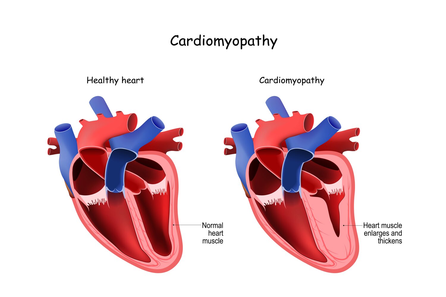 Cardiomyopathy can cause heart murmur