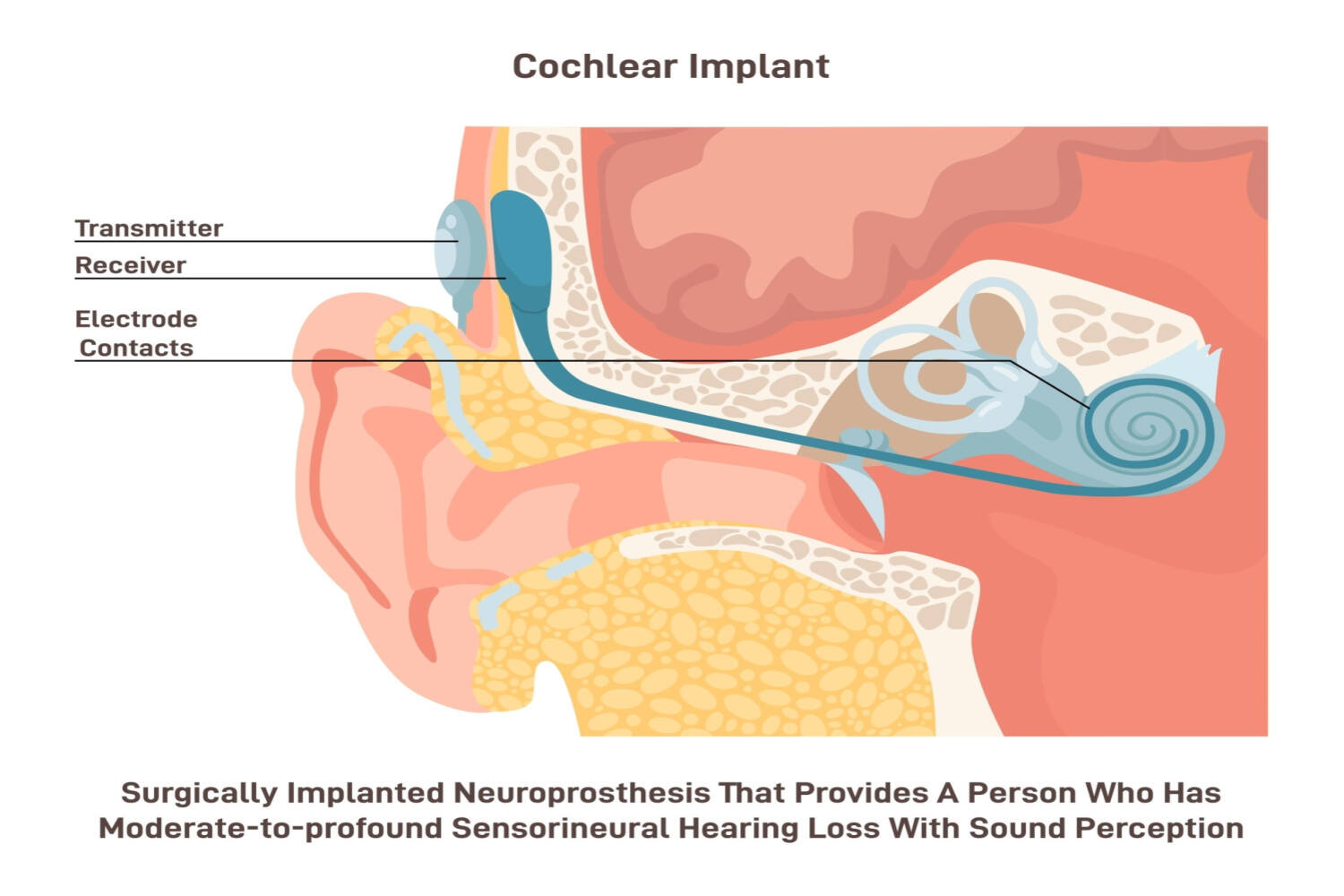 Cochlear implant