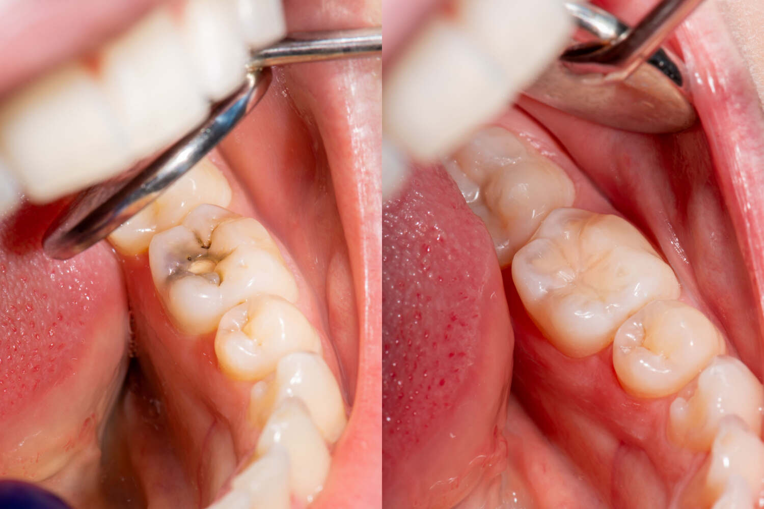 Teeth before and after filling
