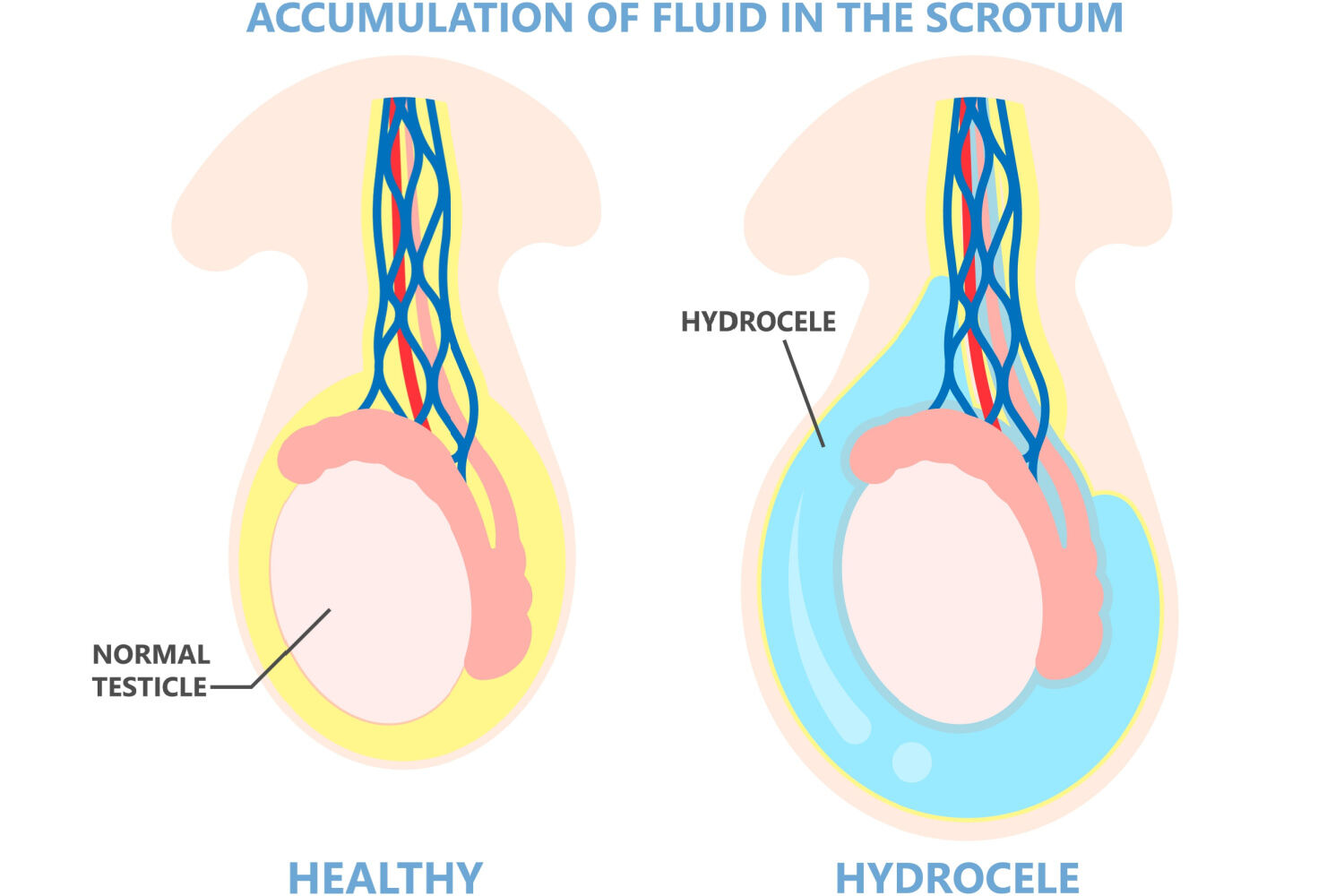 Hydrocele