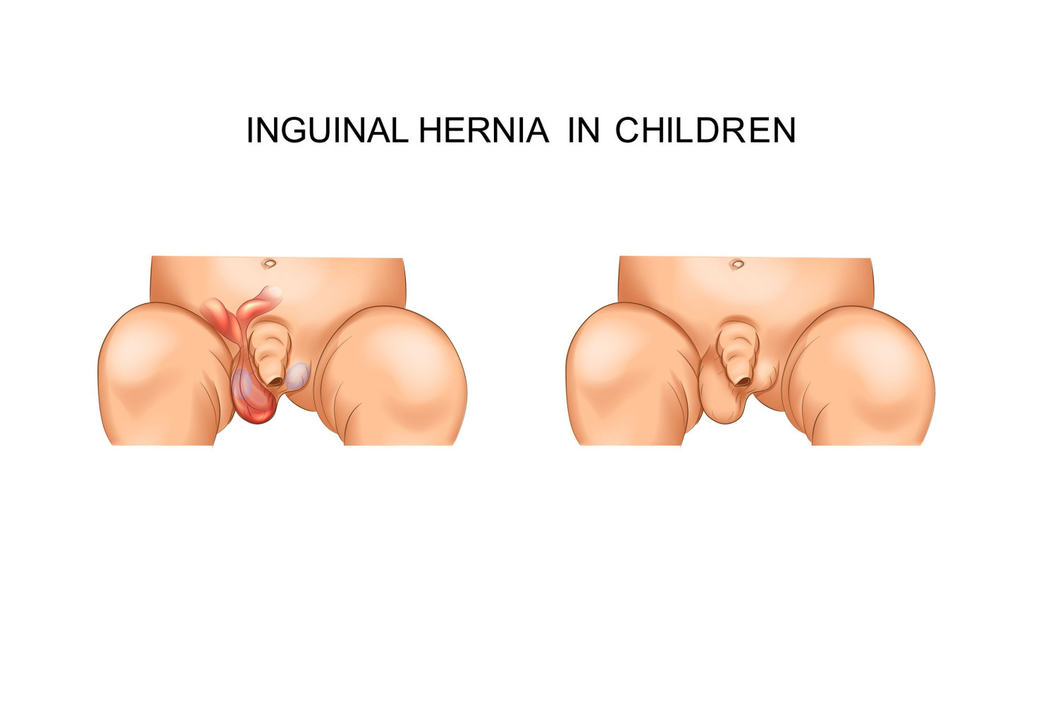 Inguinal hernia