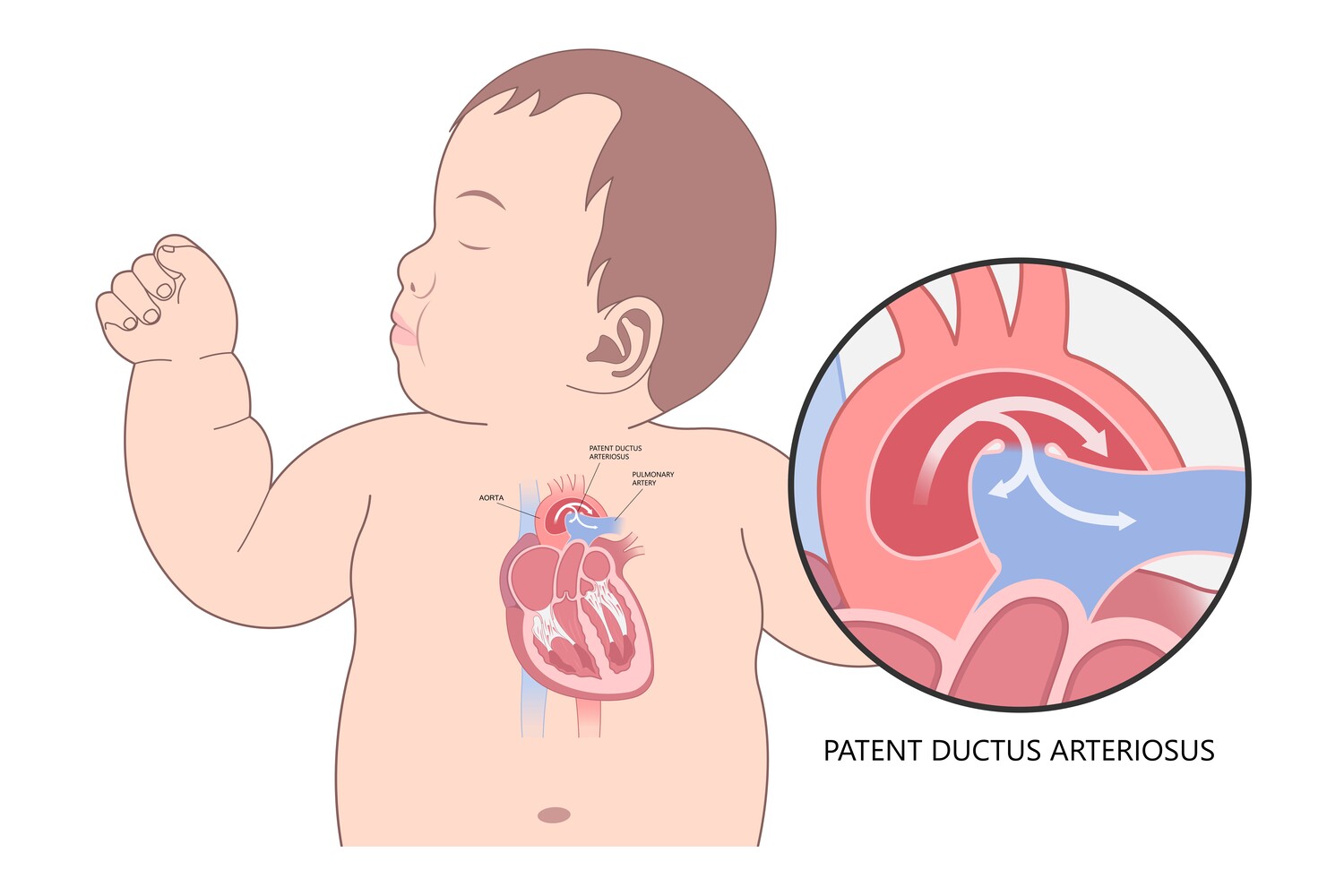 Patent ductus arteriosus