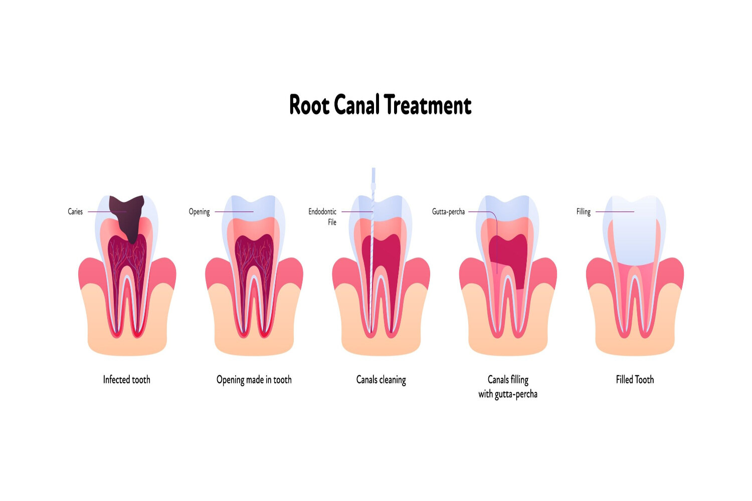 Root canal therapy