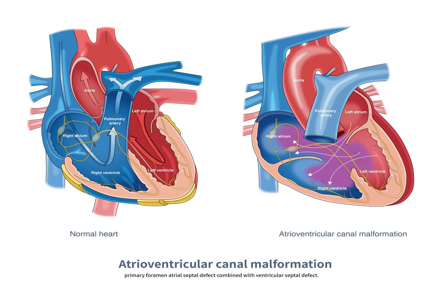 Septal defects