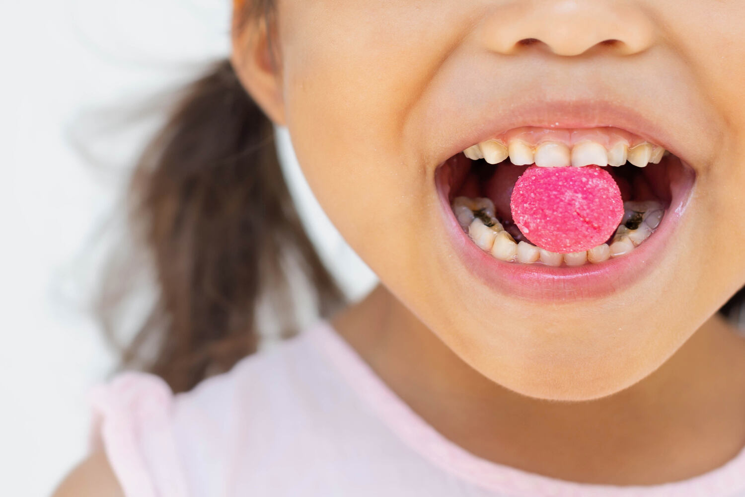 Tooth decay in kids